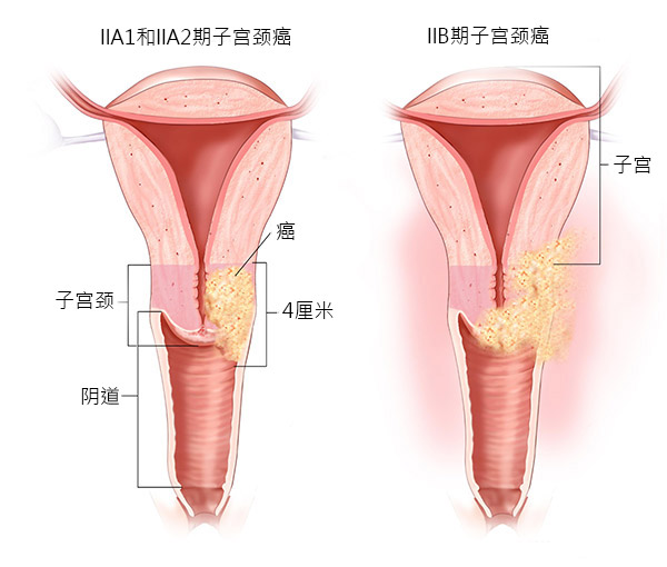 马来西亚的子宫颈癌治疗