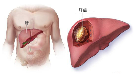 马来西亚的肝癌治疗