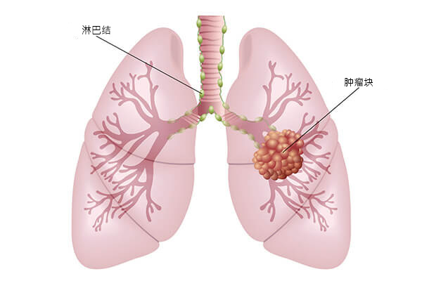 马来西亚的肺癌治疗