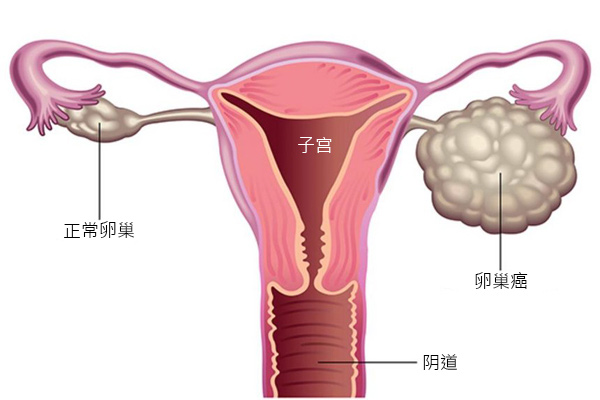 马来西亚卵巢癌的治疗