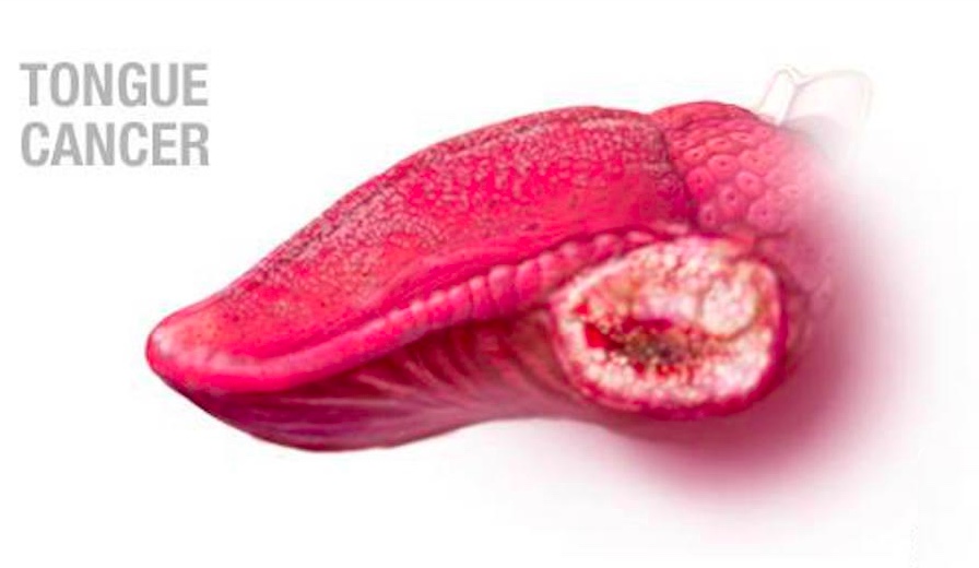马来西亚的舌癌治疗