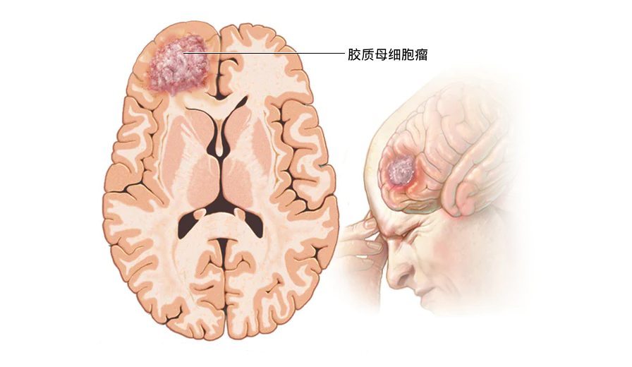 马来西亚的脑癌治疗